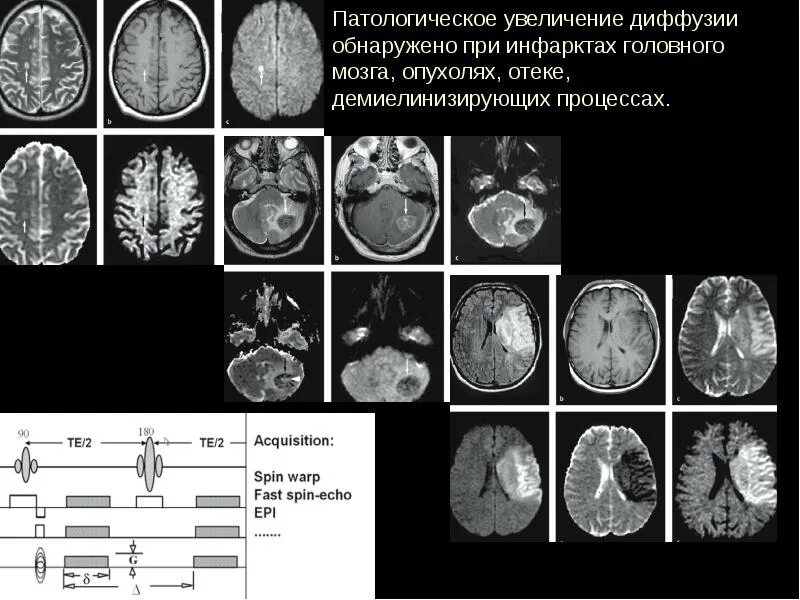 Мрт диффузия всего тела. Диффузионная мрт головного мозга. демиелинизирующие процессы головного мозга. артефакты на мрт головного мозга. физические основы мрт.