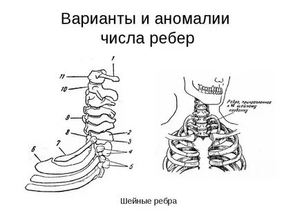 Аномалии развития ребер и грудины