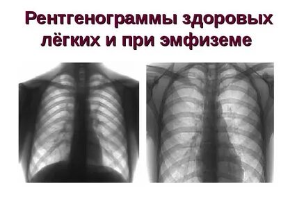 Грудная эмфизема