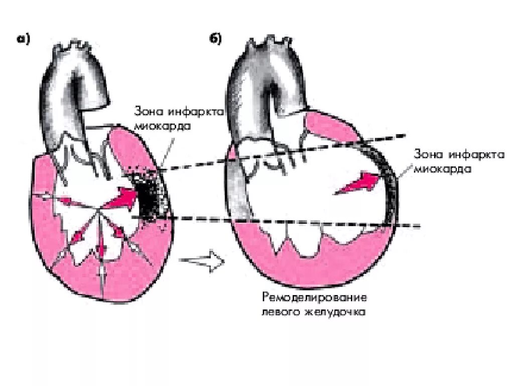 Инфаркт левого желудочка сердца. Ремоделирование при инфаркте миокарда. Расслоение миокарда левого желудочка. Трансмуральный инфаркт миокарда левого желудочка. Миокард правого желудочка сердца