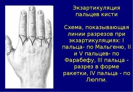 Гангрена стопы по мкб 10 у взрослых