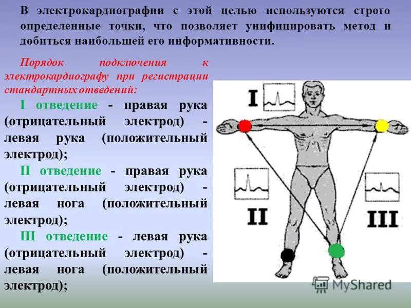 Наложение электродов ЭКГ на руки. Стандартное наложение электродов ЭКГ. Как ставятся электроды на ЭКГ. Как подключить электроды ЭКГ правильно. В каких условиях необходимо проводить исследование экг