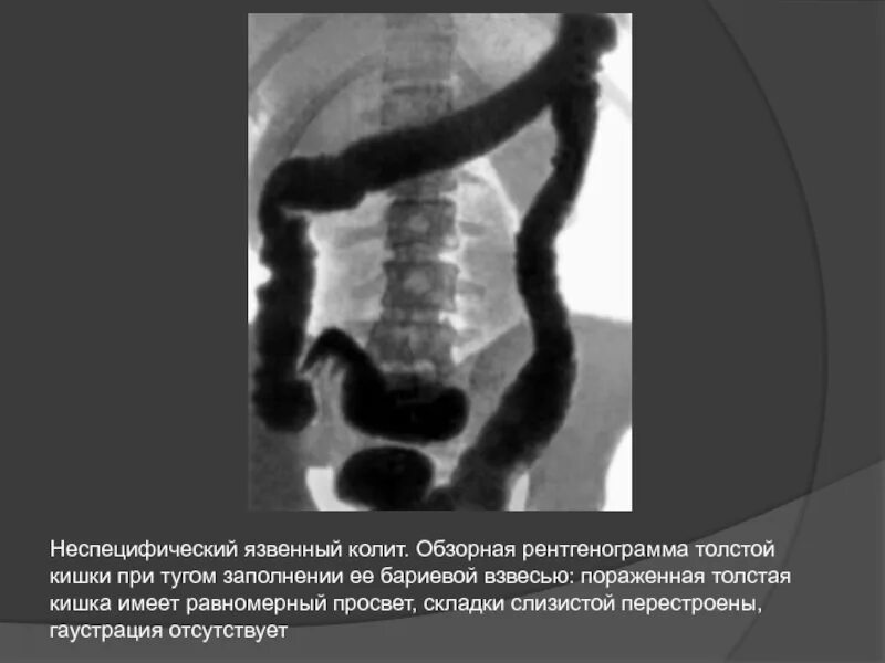 Гаустрация это