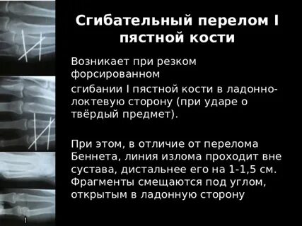 Перелом человека