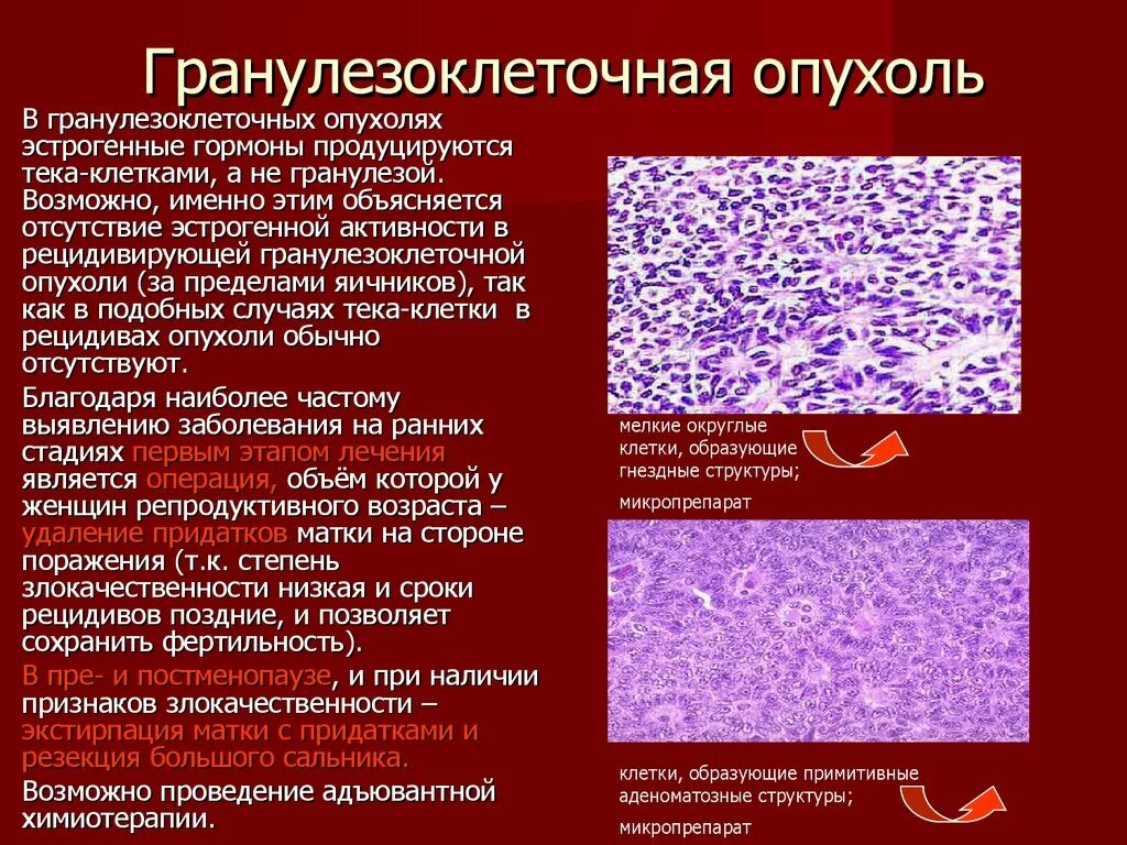 Гранулезоклеточная опухоль яичника гистология. Гранулезоклеточная опухоль злокачественная гистология. Злокачественная гранулезоклеточная опухоль яичника микропрепарат. Гранулезоклеточная опухоль яичника кт. Удалить яичники при раке