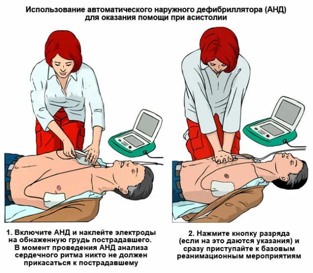 Порядок действий по использованию дефибриллятора