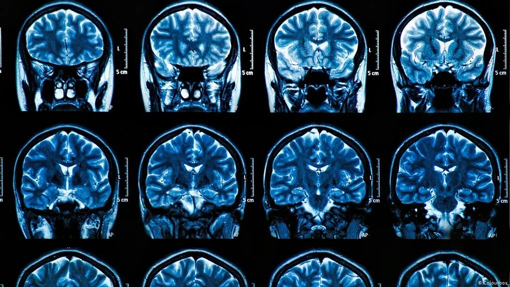 Мрт мозга опасно. Кт томограмма головного мозга. Covid-19 головного мозга мрт. Мрт снимки мозга. Снимки мрт головного мозга.