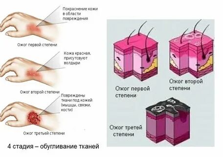 Ожоги хирургия