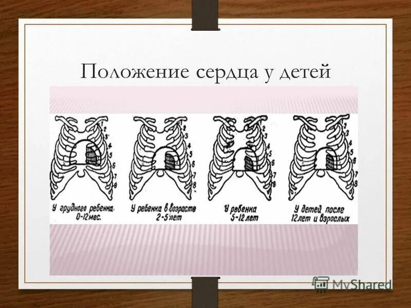 Вертикальное положение сердца у детей. Расположение сердца у детей. положение сердца у новорожденного ребенка. положение сердца у взрослого человека.