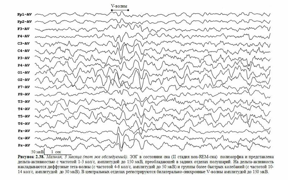 Сколько длится ээг. Эпилептиформная активность на ЭЭГ. Вертексные потенциалы на ЭЭГ. Эпилептический статус ЭЭГ. ЭЭГ головного мозга ребенку 7 лет.