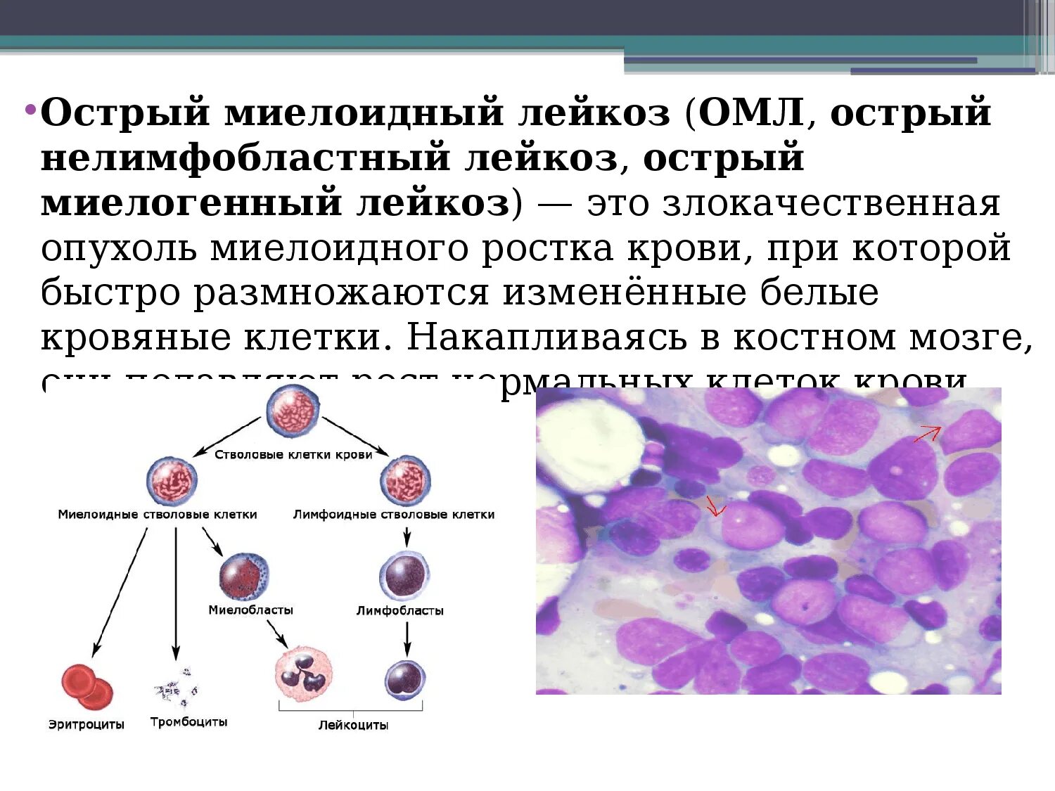 Острый моиобластный лейкоз. Острый миелоидный и лимфобластный лейкоз. Острый лейкоз миелоидный ОМЛ м3. ОМЛ лейкоз миелобластный. Лейкоз характеризуется