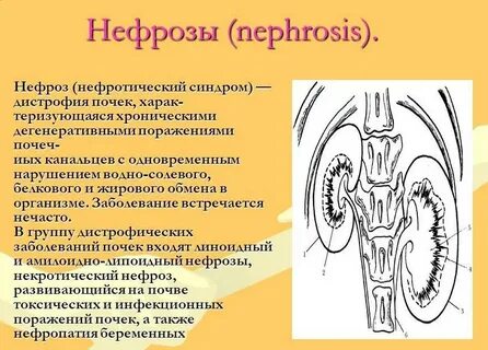 Нефрит и нефроз
