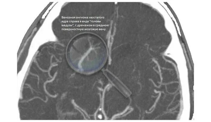 Венозная ангиома мозжечка мрт. Кавернозная ангиома мрт. Венозная ангиома головного мозга кт. Кавернозная гемангиома головного мозга кт. Ангиома правой лобной
