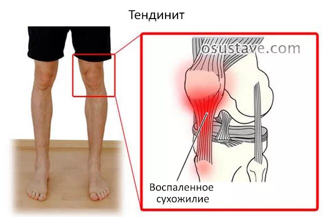 Тянущая боль в голени. Сухожилия позади колена.