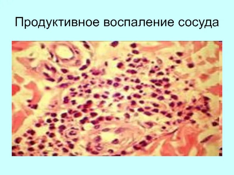 Серозное воспаление патанатомия. Хроническое воспаление патанатомия. Серозный выпот экссудат. Хроническое воспаление патанатомия. Хроническое воспаление патанатомия.