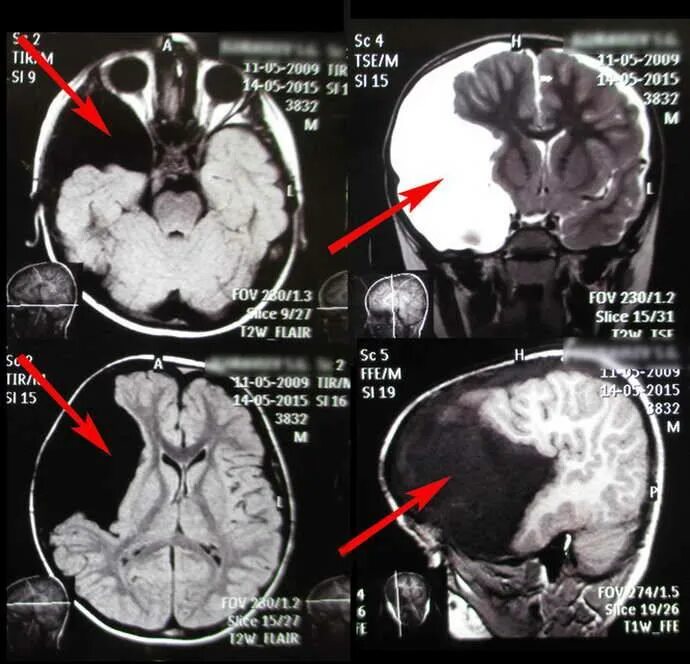 Патологии на мрт. Мрт головного мозга. Мрт снимки мозга. Снимки мрт головного мозга. Мрт головы мозга.