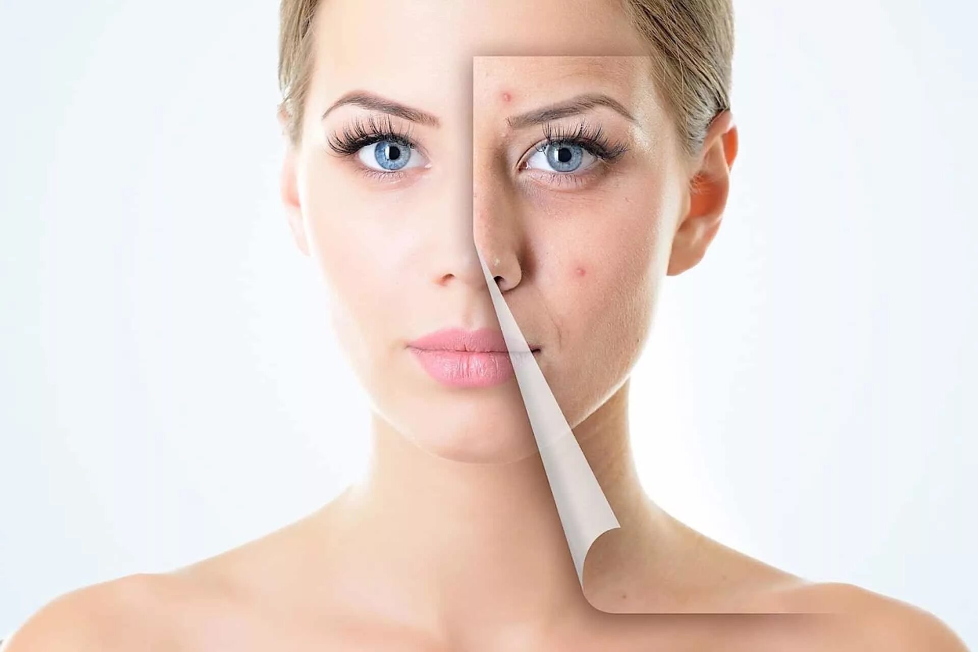 Acne pimple