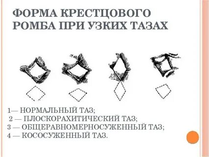 Ромб михаэлиса размеры