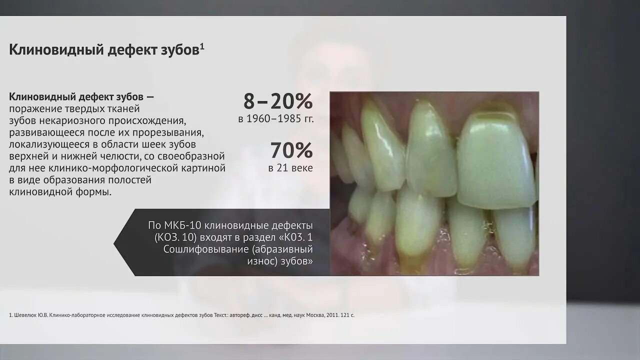 Клиновидный дефект истирание. Клиновидные дефекты на резцах. Клиновидный дефект зубов 4 стадия. Пришеечный дефект зубов. Больно стучать по зубу