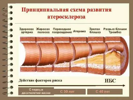 Атеросклероз биохимия