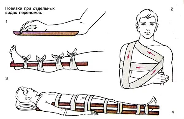 При переломе в первую очередь. Накладывание шины при переломе. Оказание первой помощи при переломах костей. Первая доврачебная помощь при переломах костей. Шинирование при переломе костей.