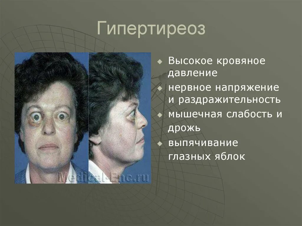 Гипертиреоз dr md ru. Гипертиреоз и тиреотоксикоз. Внешние симптомы гипертиреоза.