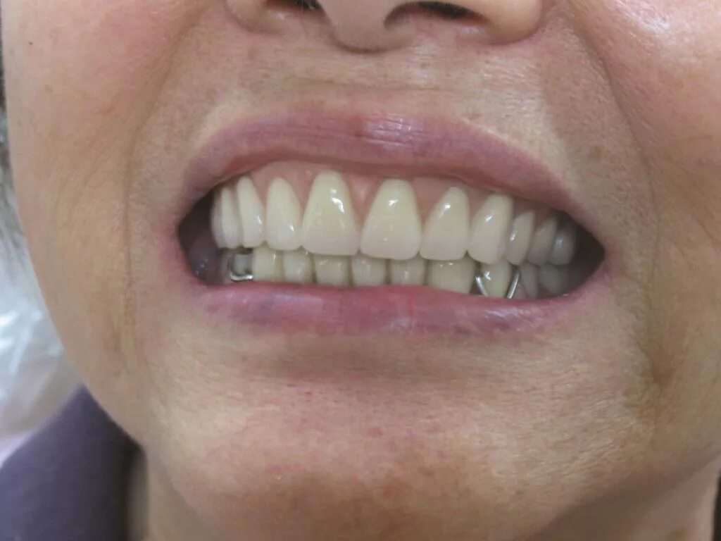 Снимать ли зубные протезы на ночь. Частичный съемный протез во рту. Съемные протезы передних зубов. Вставной протез на верхнюю челюсть. Съемные протезы на передние зубы верхней челюсти.