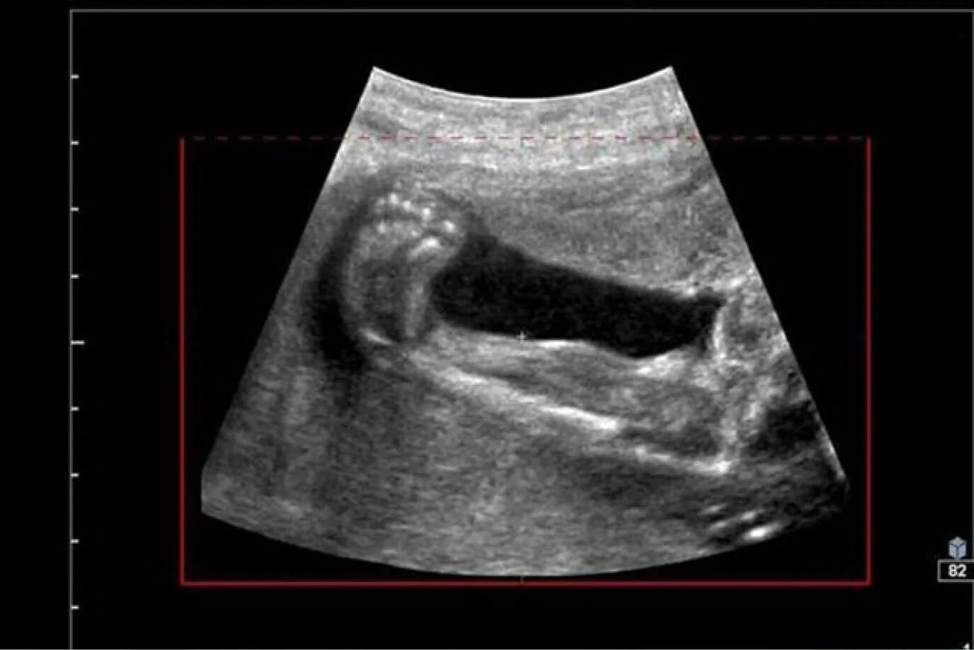 большой плод по узи. узи 16 недель беременности. измерение бипариетального размера головки плода узи. узи носовой кости плода.