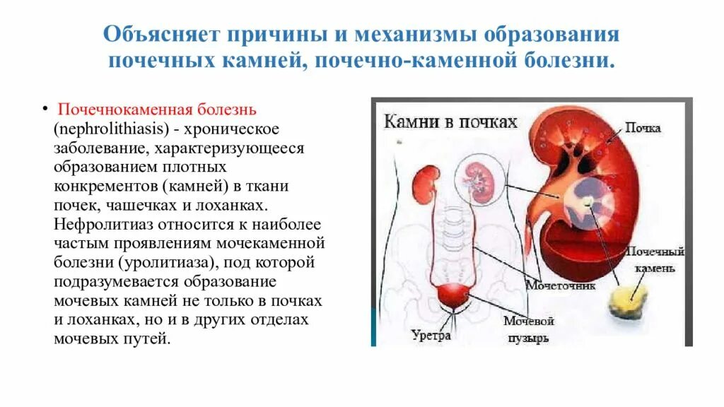 Причины почечных заболеваний. Этиология расстройств функций почек. Почечнокаменная болезнь механизмы образования почечных камней. Формирование конкрементов в почках. Факторы образования камней в почках.