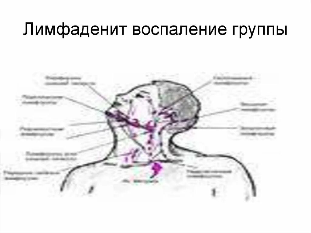 Надключичные лимфоузлы. Лимфаденит надключичных лимфоузлов. Надключичный лимфоузел воспален. Острый лимфаденит подчелюстной области. Прощупывается лимфоузел на шее