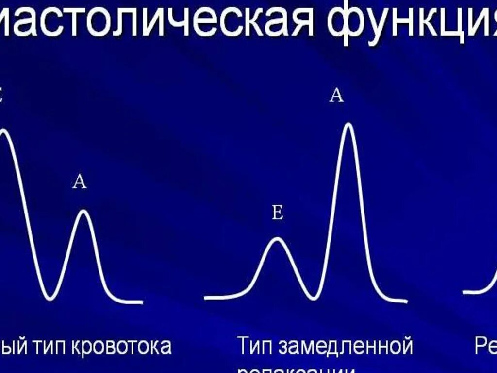 Оценка диастолической дисфункции. Нарушение диастолической функции. Типы диастолической дисфункции. Типы нарушения диастолической функции лж.