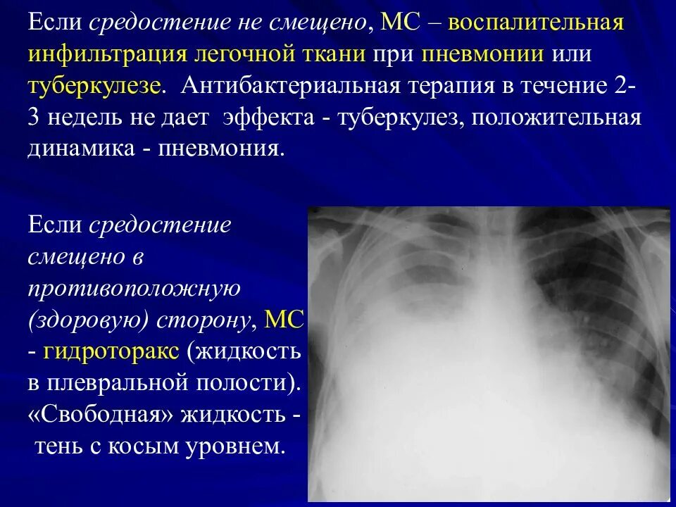 Инфильтрация при пневмонии. Инфильтрация легочной ткани. Инфильтрация легочной ткани при пневмонии. Положительная динамика при пневмонии.