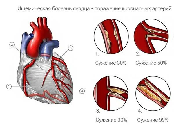 Факторы ишемии. Ишемичкскаяболезнь сердца. Ишемическая болезнь сердца причины. Ишемическая болезнь сердца (ИБС).