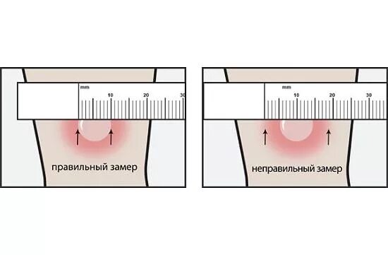 Сколько раз делается манту. Проба манту папула 10 мм. Реакция манту у ребенка 3 года норма. Нормальная реакция манту у ребенка 1. Реакция манту норма у детей 10 лет.