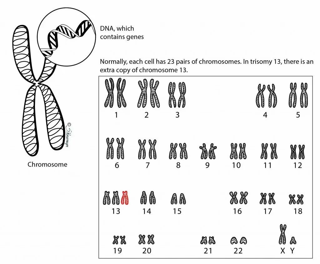Пересадка хромосом. Синдром Патау трисомия хромосомы 13. Синдром Патау хромосомная карта. Транслокационная форма синдрома Патау кариотип. Кариотип человека при синдроме Патау.