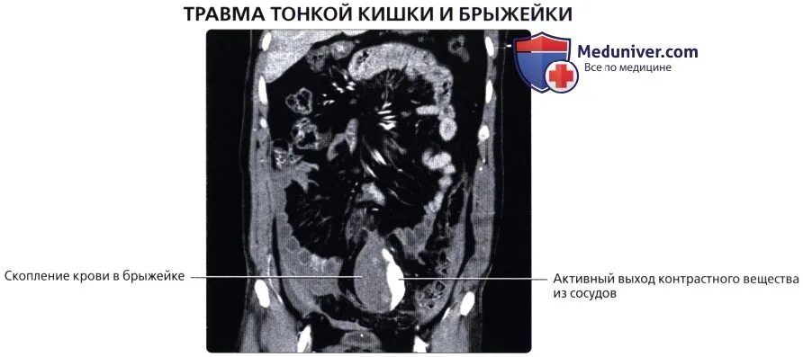 Брыжейка толстой кишки кт. Брыжейка тонкой кишки на кт. Лимфома брыжейки тонкой кишки кт. Тонкий кишечник кт анатомия.