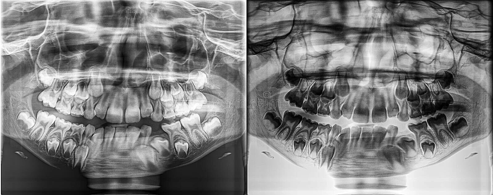 Рентген черепа ребенка зубы. Рентген черепа с молочными зубами. Гипердонтия снимок черепа.