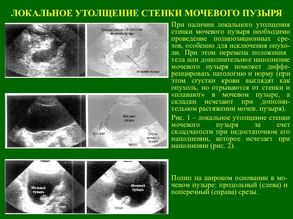 Толщина стенки мочевого пузыря в норме на УЗИ. Стенка мочевого пузыря норма по УЗИ. Стенки мочевого пузыря утолщены УЗИ. УЗИ мочевого пузыря показатели в норме.