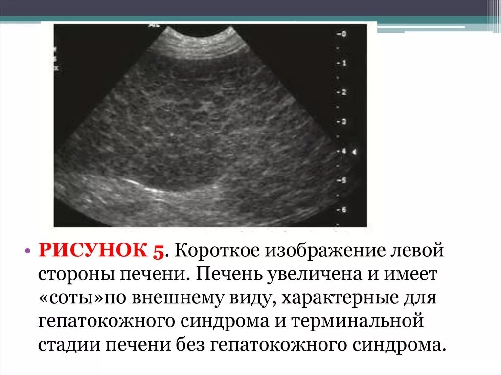 Увеличена область печени. Структура печени при циррозе на УЗИ. Узлы регенерации печени при циррозе на УЗИ. Внешний вид увеличенной печени.