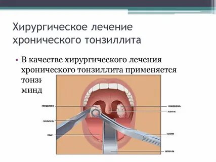 Лекарство от воспаления гланд