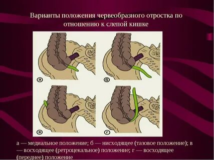 Варианты аппендикса