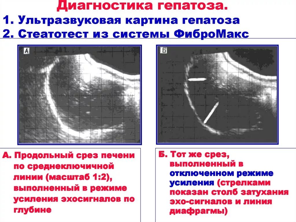 Признаки жировой печени