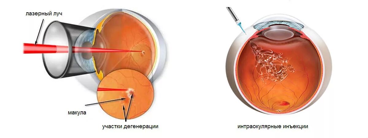 Панретинальная лазерная коагуляция. Периферическая профилактическая лазеркоагуляция сетчатки. Отслойка сетчатки лазерная коагуляция. Барьерная лазерная коагуляция сетчатки. Лазерная коагуляция после операции