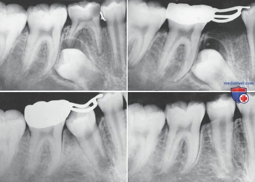 Рентген молочных зубов. Распорка для молочных зубов.