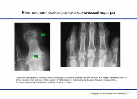 Рентгенологические признаки подагры