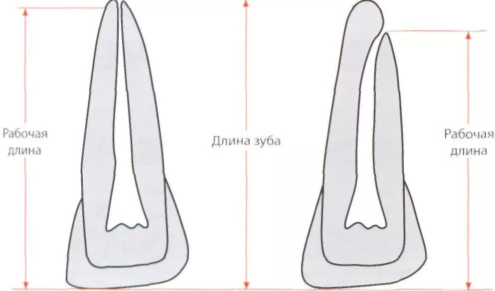 Определение корневых каналов. Рабочая длина корневого канала. Длина корневых каналов зубов. Измерение рабочей длины корневого канала. Измерение длины канала зуба.