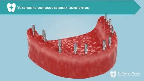 Институт базальной имплантации