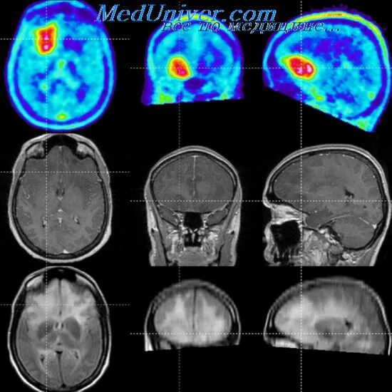 Глиальная опухоль головного мозга кт. Глиома головного мозга кт. ПЭТ-кт глиобластома. Диагнозы опухоли мозга