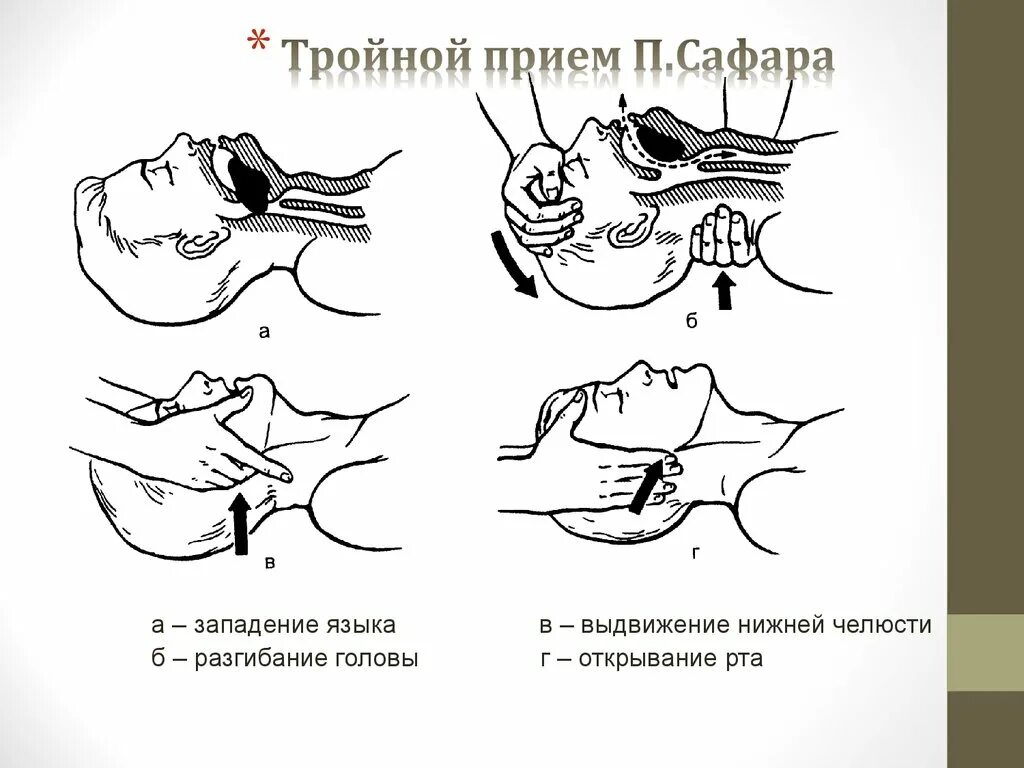 Тройной прием алгоритм. Западение языка прием Сафара. Прием при западении языка. Западение языка при СЛР.