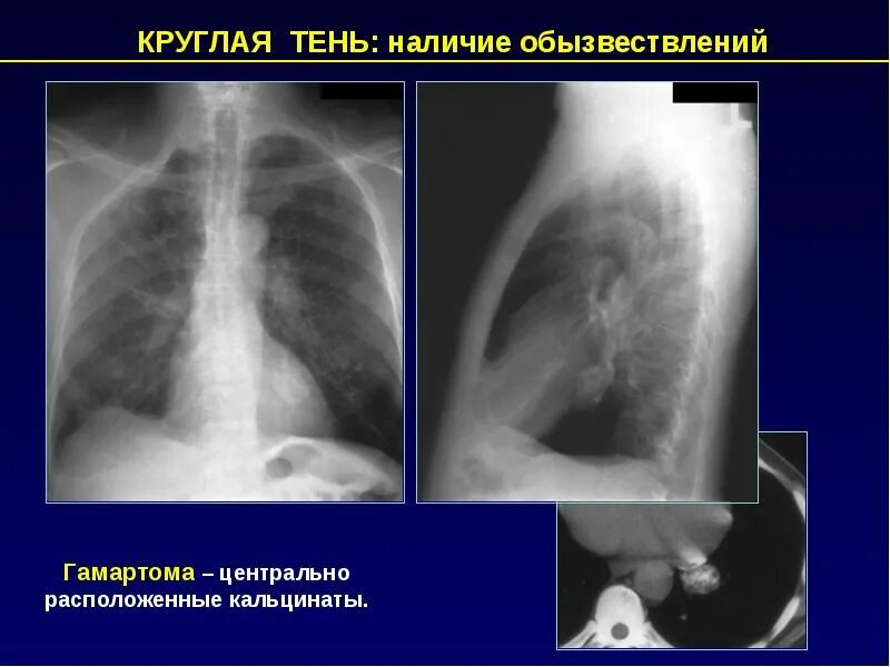 Гамартома легкого рентген. Гамартохондрома легкого на рентгене. Гамартома на рентгенограмме. Гамартохондрома легкого что это. Образование в легких что это может быть